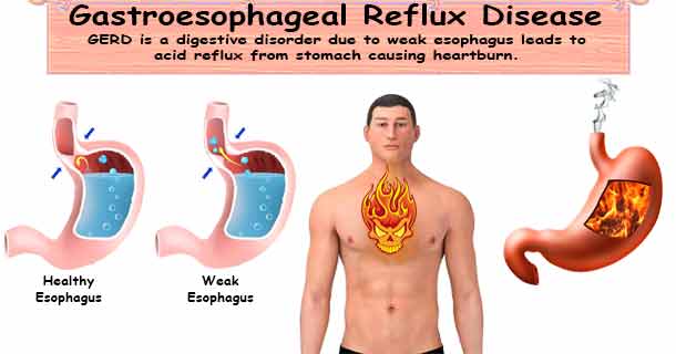 Gastroesophageal Reflux Disease (GERD)