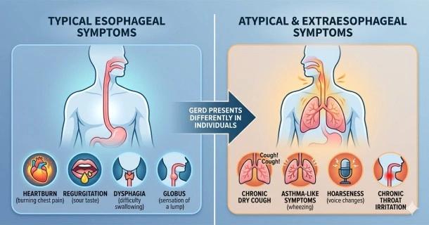 Medical infographic split into two sections comparing typical esophageal GERD symptoms like heartburn and regurgitation against atypical extraesophageal symptoms like chronic cough, asthma, and hoarseness.