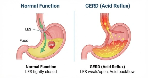 Medical illustration contrasting a normal stomach with a closed lower esophageal sphincter versus acid reflux in GERD where the sphincter relaxes and allows stomach acid into the esophagus.