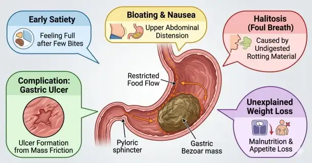 Medical infographic displaying the common clinical symptoms of a gastric bezoar mass, highlighting early satiety, severe bloating, foul breath from fermentation, and friction-induced gastric ulcers.