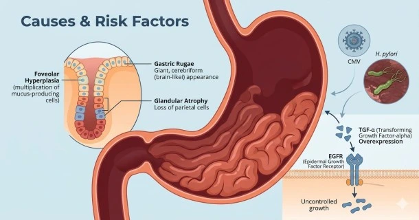 • Medical diagram showing the underlying causes of Ménétrier's disease, highlighting the cellular pathway of TGF-α binding to EGFR, alongside environmental triggers like CMV for children and H. pylori for adults.