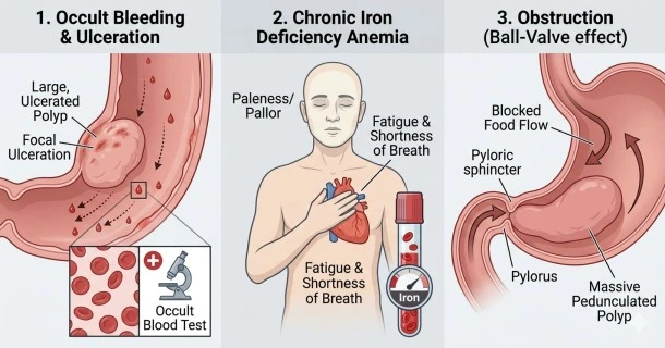 • Medical infographic illustrating three primary symptoms of large stomach polyps: occult bleeding from surface ulcers, secondary chronic iron deficiency anemia, and gastric outlet obstruction via a ball-valve effect.
